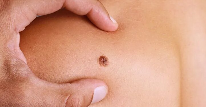 Metastatic Melanoma: Symptoms, Stages, Treatment
